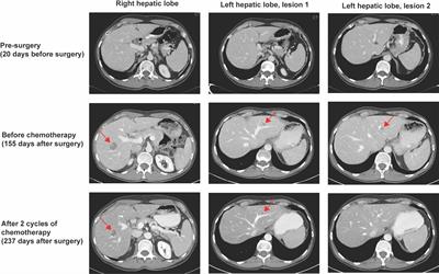 Post-operative ctDNA monitoring in stage I colon cancer: A case report